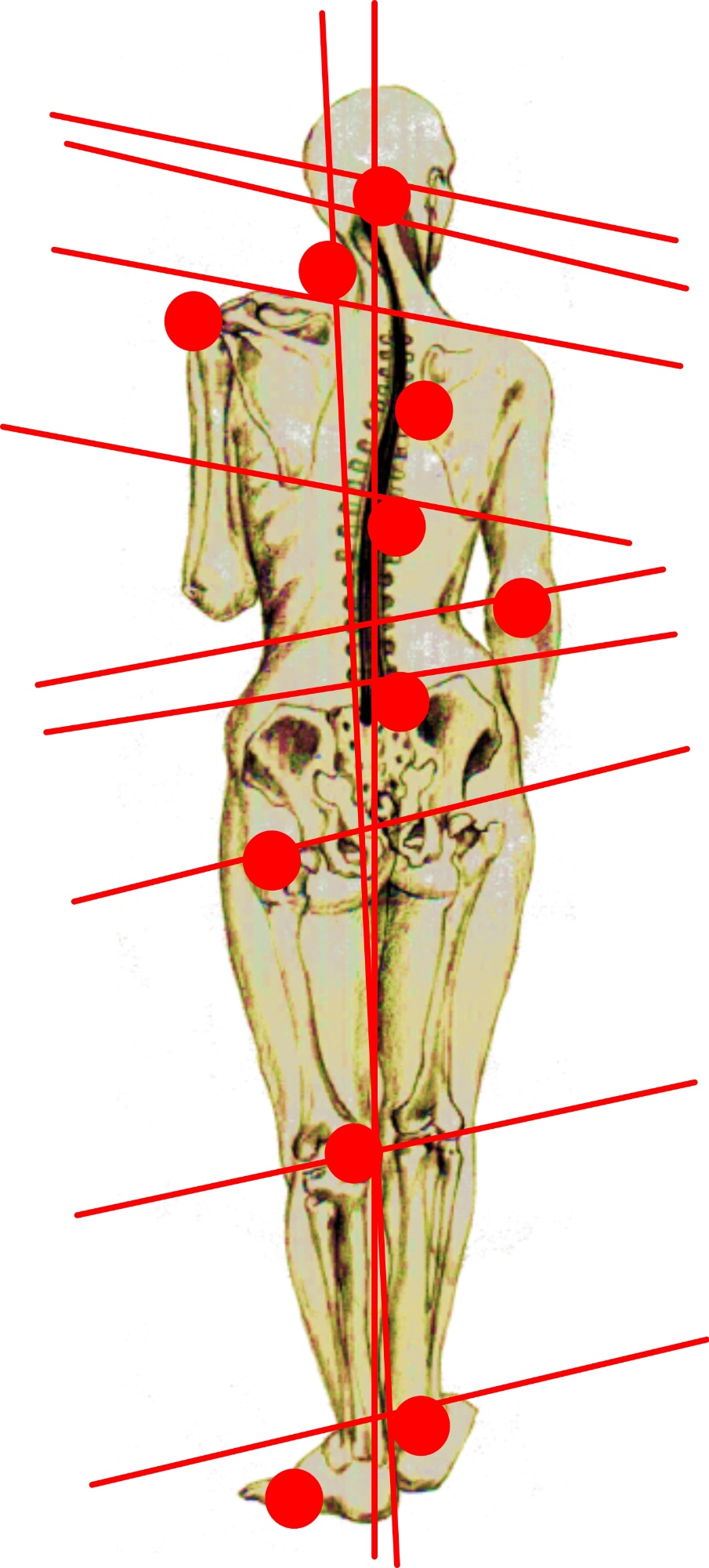 Pelvic misalignment and full body compensation diagram